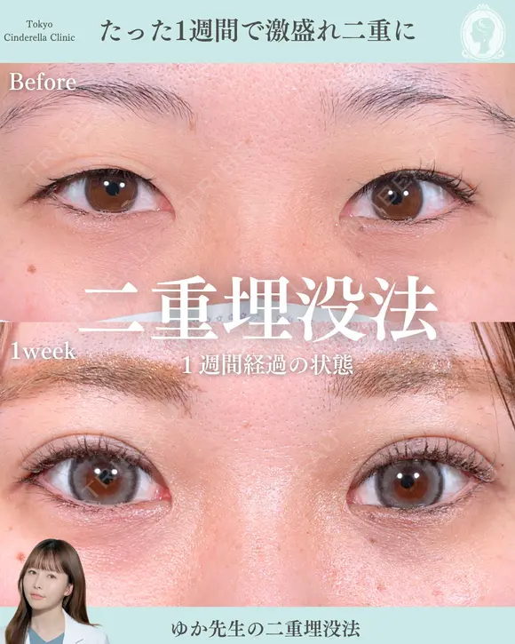 二重埋没法 7日後 メイン用