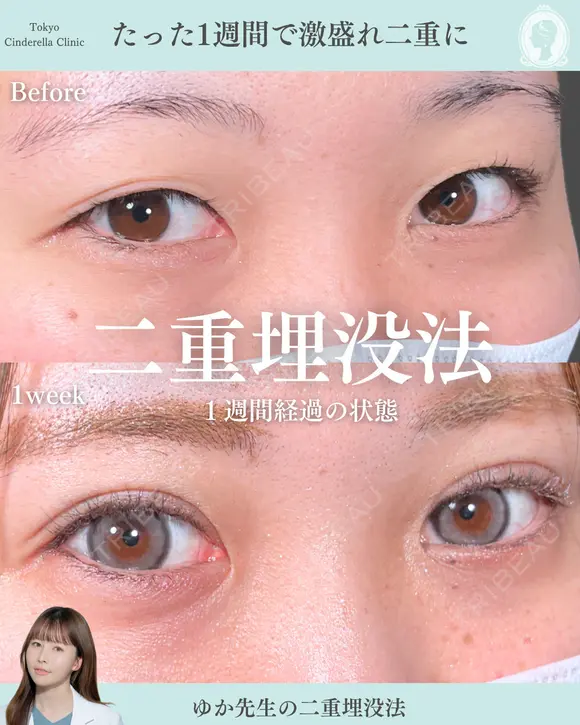 二重埋没法 before画像 メイン用