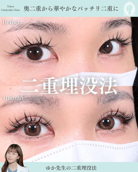 二重埋没法 before画像 メイン用