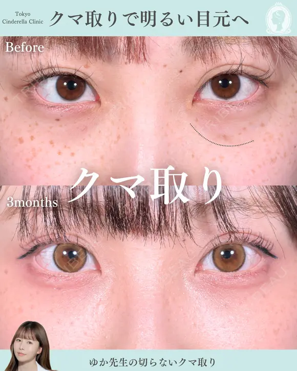 切らないクマ取り 180日後 メイン用