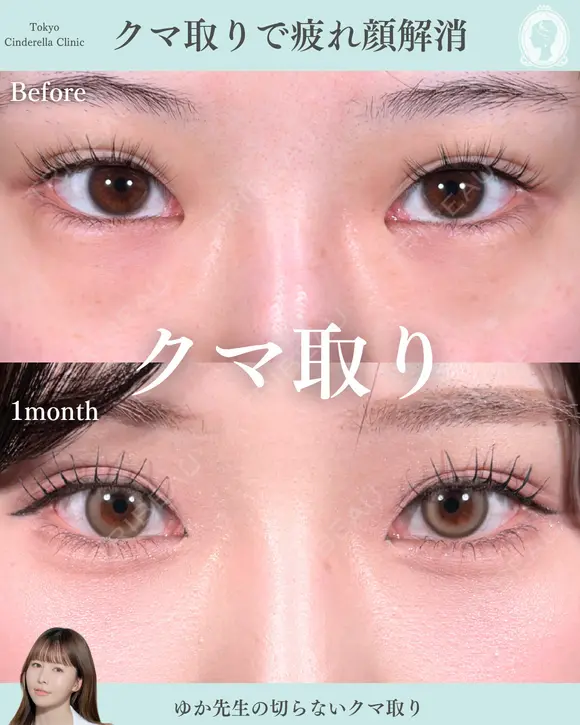 切らないクマ取り 30日後 メイン用