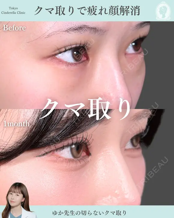 切らないクマ取り before画像 メイン用