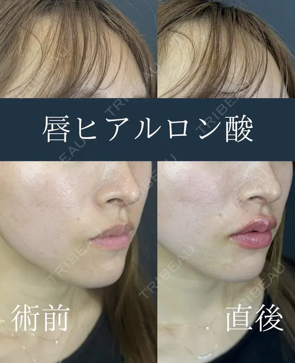 Cカールリップ(ボルベラ)　口角ボトックス(アラガン社製) after画像 メイン用