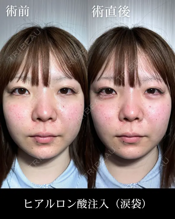 ヒアルロン酸注入（涙袋） before画像 メイン用