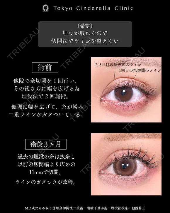 たるみ取り併用全切開法二重術/眼瞼下垂手術/埋没法抜糸/他院修正/MD式 before画像 メイン用
