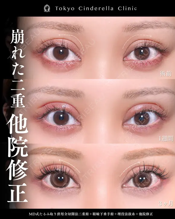たるみ取り併用全切開法二重術/眼瞼下垂手術/埋没法抜糸/他院修正/MD式 90日後 メイン用