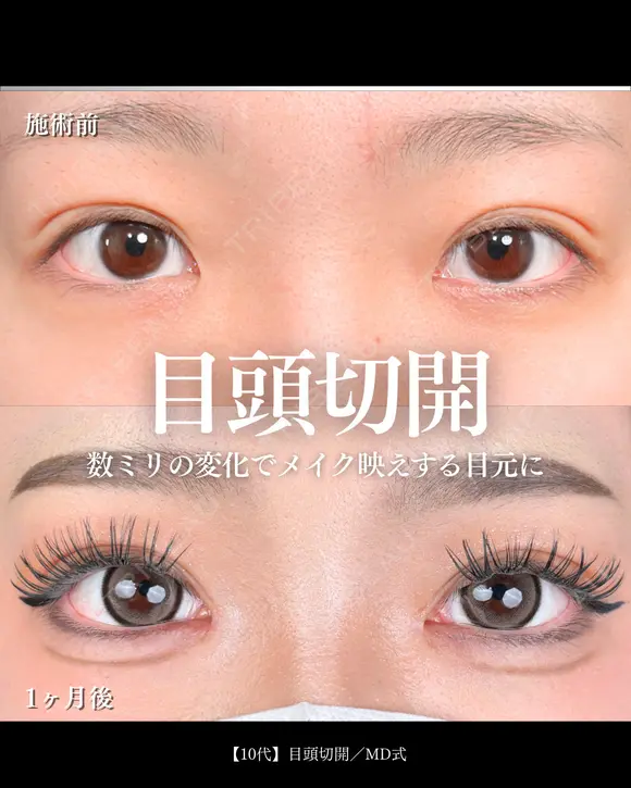 目頭切開/MD式 30日後 メイン用