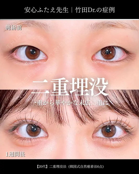 二重埋没法(韓国式自然癒着法6点) 7日後 メイン用