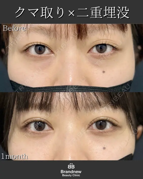 二重埋没＋脱脂＋脂肪注入（コンデンスリッチ） before画像 メイン用