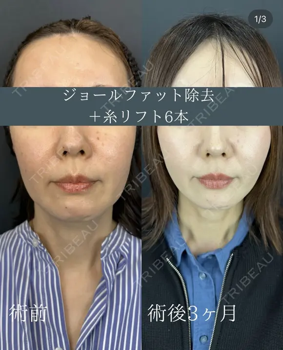 ルラリフト6本+ジョールファット除去 after画像 メイン用