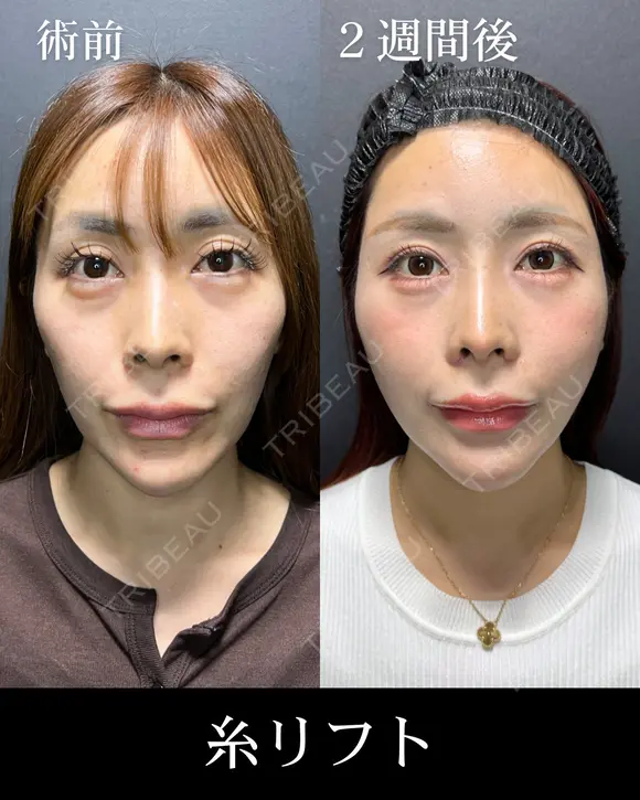 糸リフト after画像 メイン用