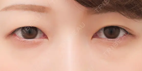 埋没法プレミアム before画像 メイン用