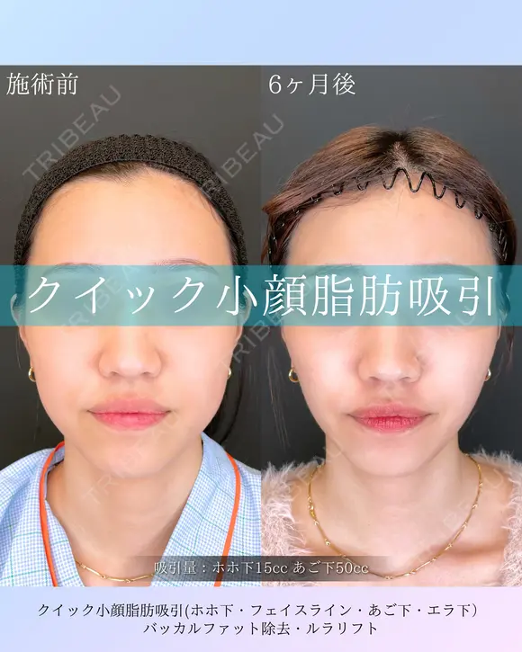 クイック小顔脂肪吸引・バッカルファット除去・ルラリフト after画像 メイン用