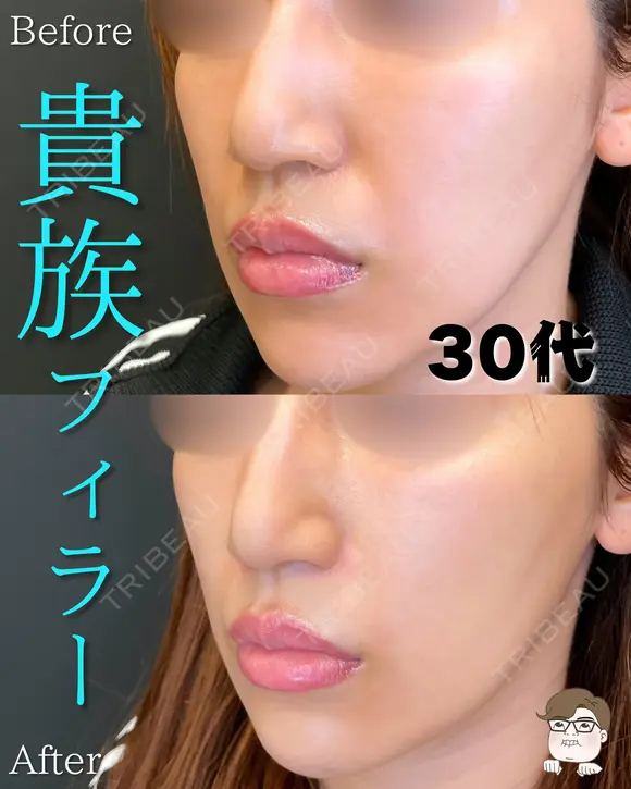 貴族フィラー after画像 メイン用