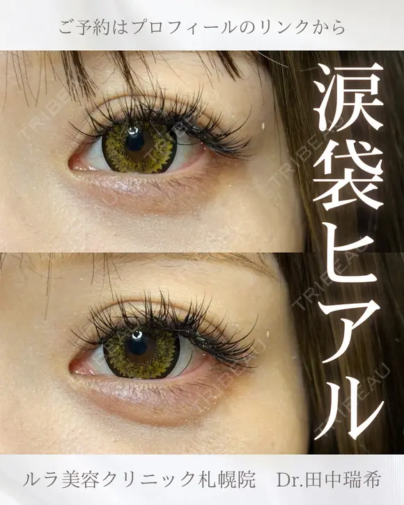 涙袋ヒアルロン酸注入 after画像 メイン用