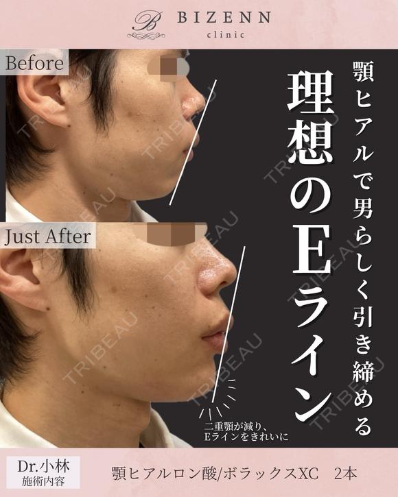顎のヒアルロン酸 after画像 メイン用