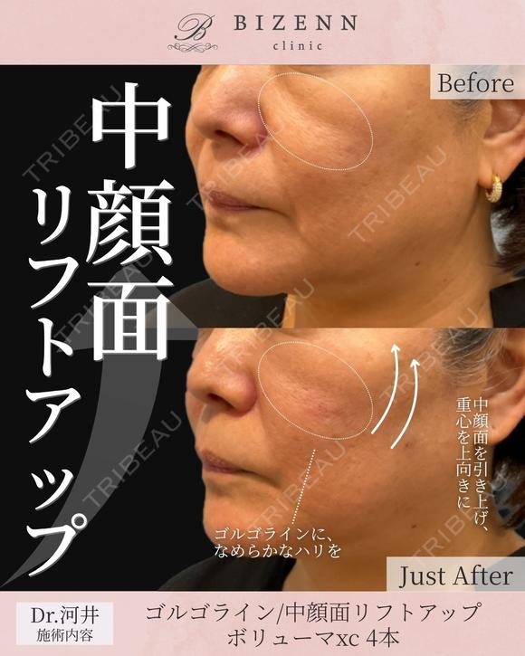 中顔面リフトアップ　ヒアルロン酸 before画像 メイン用