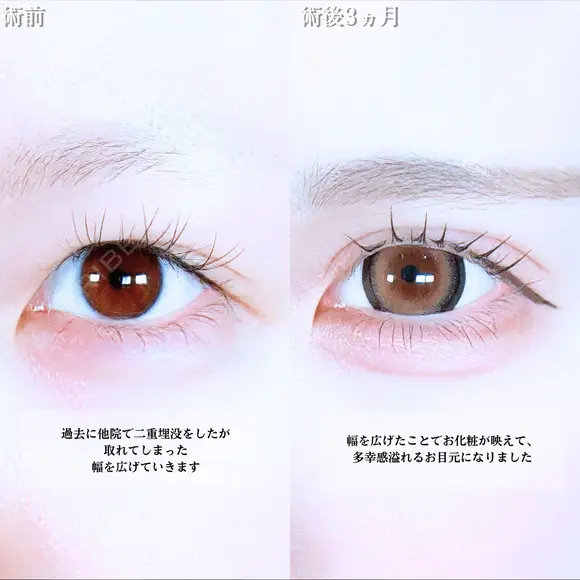 アリエルクイックループダブル二重埋没法/まぶたの脂肪取り before画像 メイン用