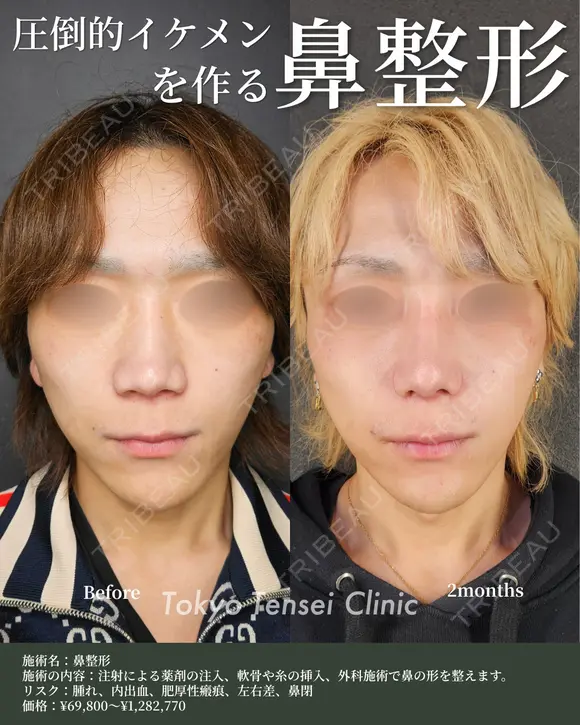 転生鼻尖形成（耳甲軟骨移植）＋小鼻縮小＋プロテーゼ＋鼻中隔延長 30日後 メイン用