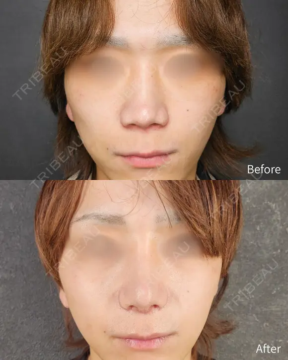 転生鼻尖形成（耳甲軟骨移植）＋小鼻縮小＋プロテーゼ＋鼻中隔延長 7日後 メイン用