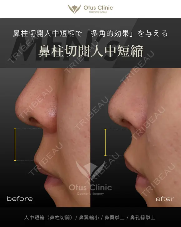 人中短縮（鼻柱切開）・鼻翼縮小・鼻翼挙上・鼻孔縁挙上  before画像 メイン用