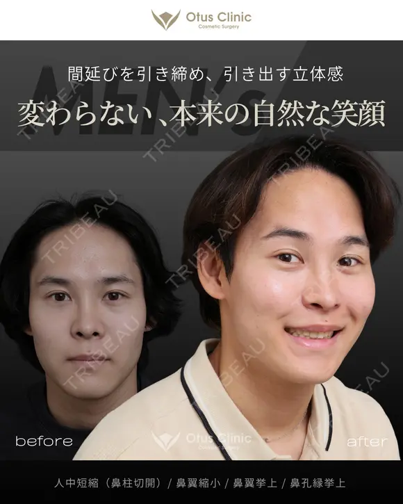 人中短縮（鼻柱切開）・鼻翼縮小・鼻翼挙上・鼻孔縁挙上  90日後 メイン用