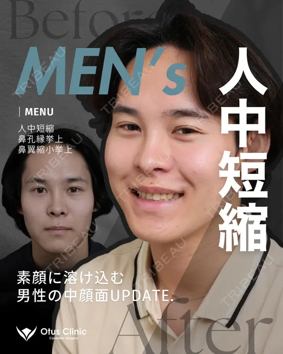 人中短縮（鼻柱切開）・鼻翼縮小・鼻翼挙上・鼻孔縁挙上  before画像 メイン用