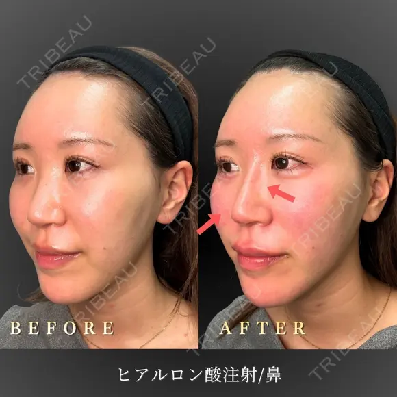 鼻ヒアルロン酸注入 after画像 メイン用