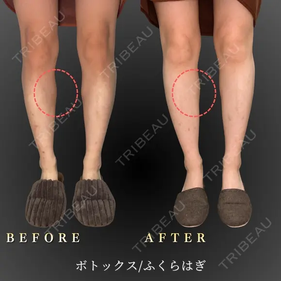 ふくらはぎボトックス before画像 メイン用