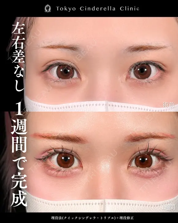 二重埋没法(クイックシンデレラ・トリプル)/埋没修正 before画像 メイン用