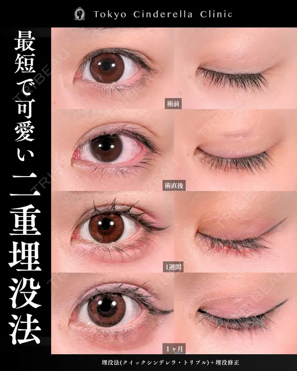 二重埋没法(クイックシンデレラ・トリプル)/埋没修正 30日後 メイン用