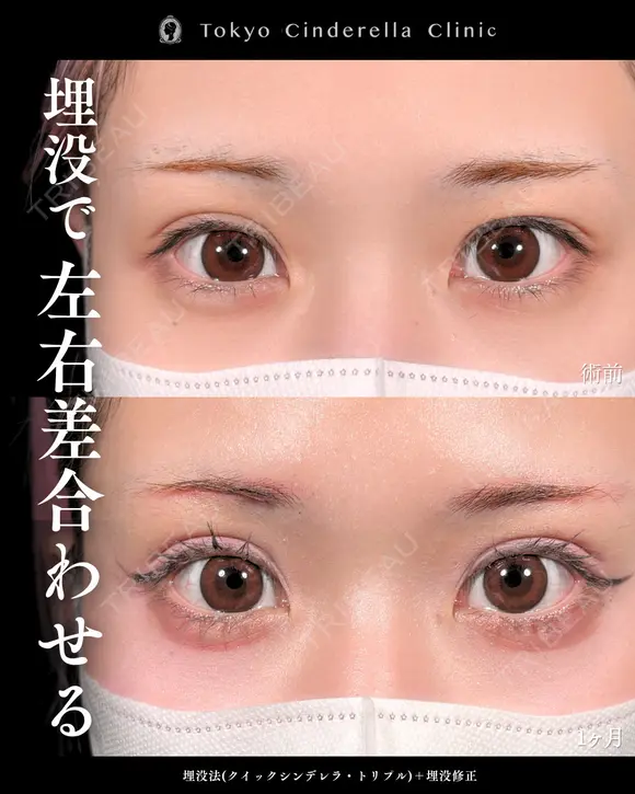 二重埋没法(クイックシンデレラ・トリプル)/埋没修正 before画像 メイン用
