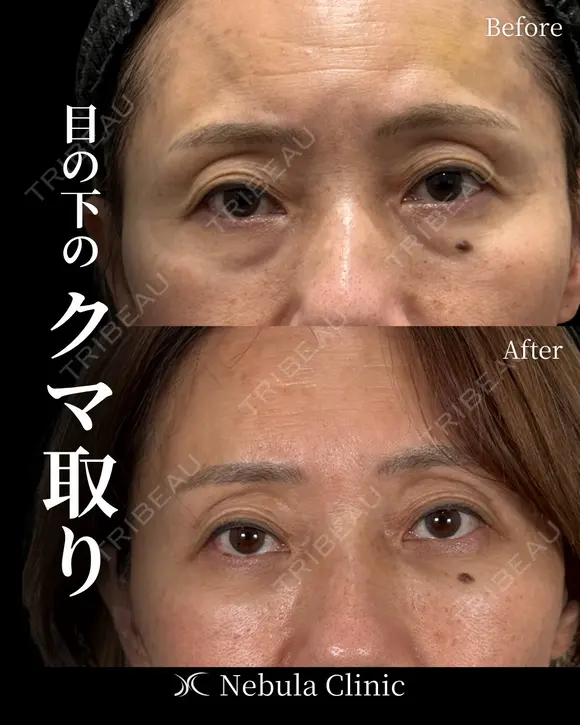 ⭐都築Dr⭐切らないクマ取り after画像 メイン用