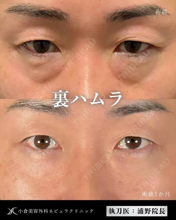 Dr浦野執刀🌿切らない目の下のクマ取り before画像 メイン用