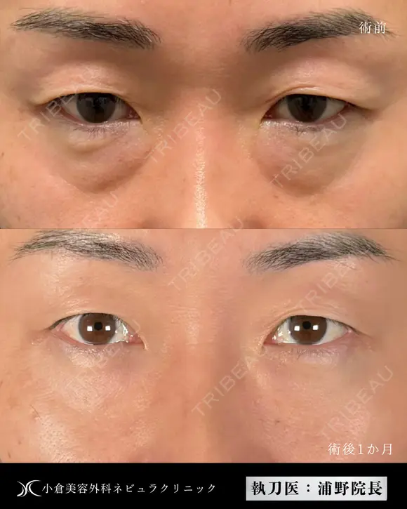 Dr浦野執刀🌿切らない目の下のクマ取り after画像 メイン用