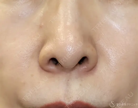 【40代女性・鼻の穴が見えるのが気になる】鼻孔縁下降術（1ヶ月後） before画像 メイン用