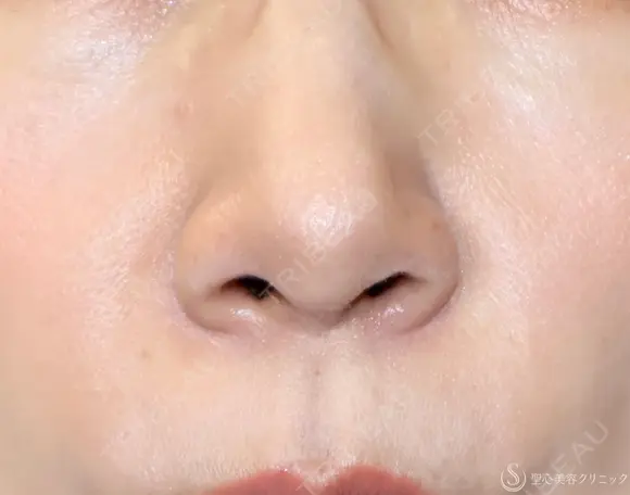 【40代女性・鼻の穴が見えるのが気になる】鼻孔縁下降術（1ヶ月後） 30日後 メイン用