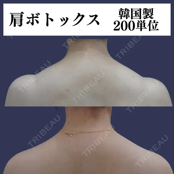 肩ボトックス before画像 メイン用