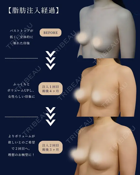 ナチュラルにサイズアップ🩷 before画像 メイン用