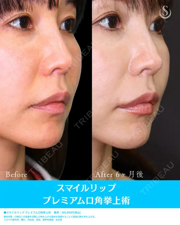 プレミアム口角挙上 before画像 メイン用