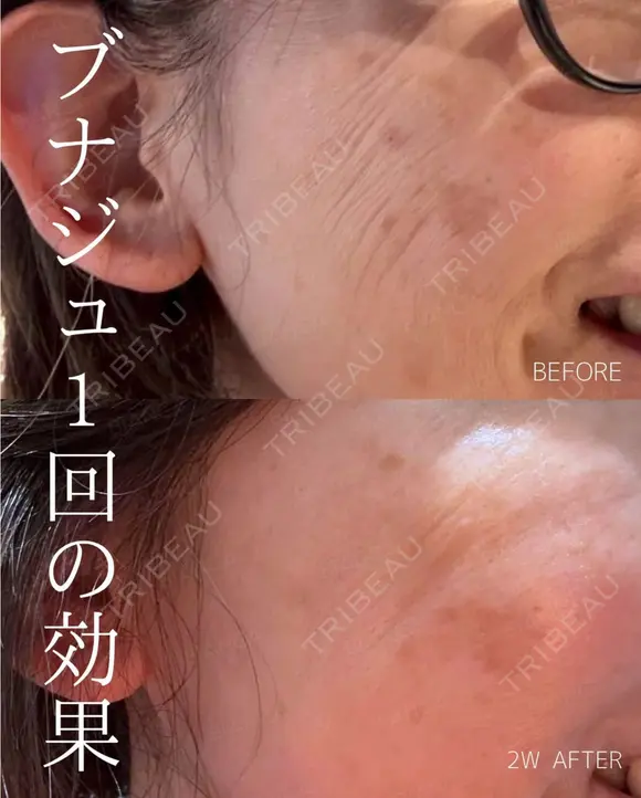 ブナジュ before画像 メイン用