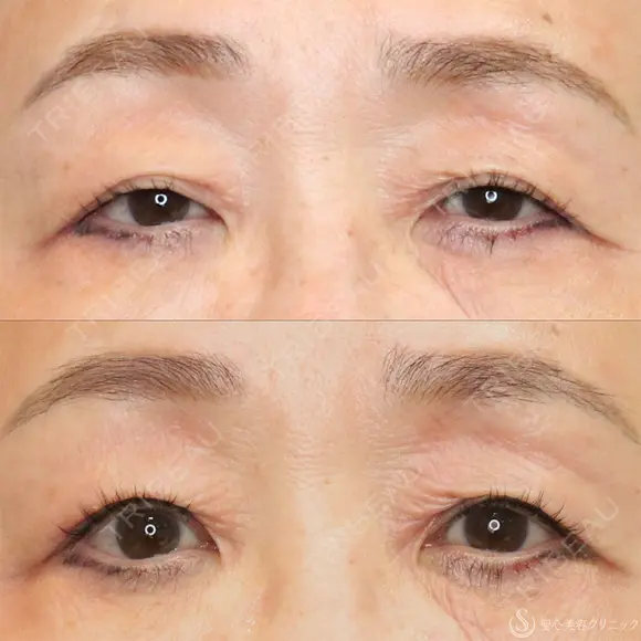 【60代女性・目の開きを改善】眼瞼下垂（埋没法）＋二重埋没法（マイクロメソッド＋α）（2ヶ月後） 30日後 メイン用
