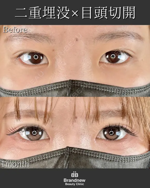 二重埋没＋目頭切開 before画像 メイン用