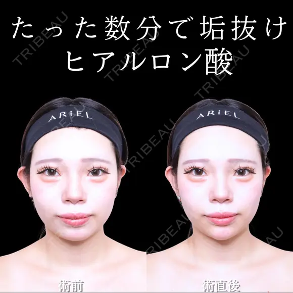 顎ヒアルロン酸 0日後 メイン用