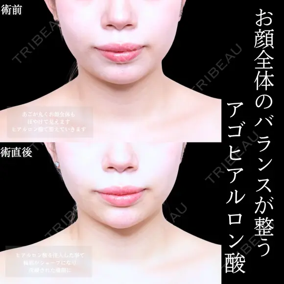 顎ヒアルロン酸 before画像 メイン用