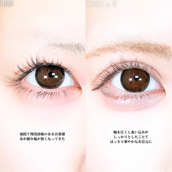 アリエルクイックループダブル二重埋没法  before画像 メイン用