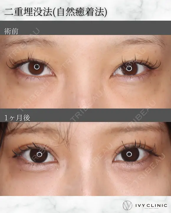 二重埋没(自然癒着) after画像 メイン用