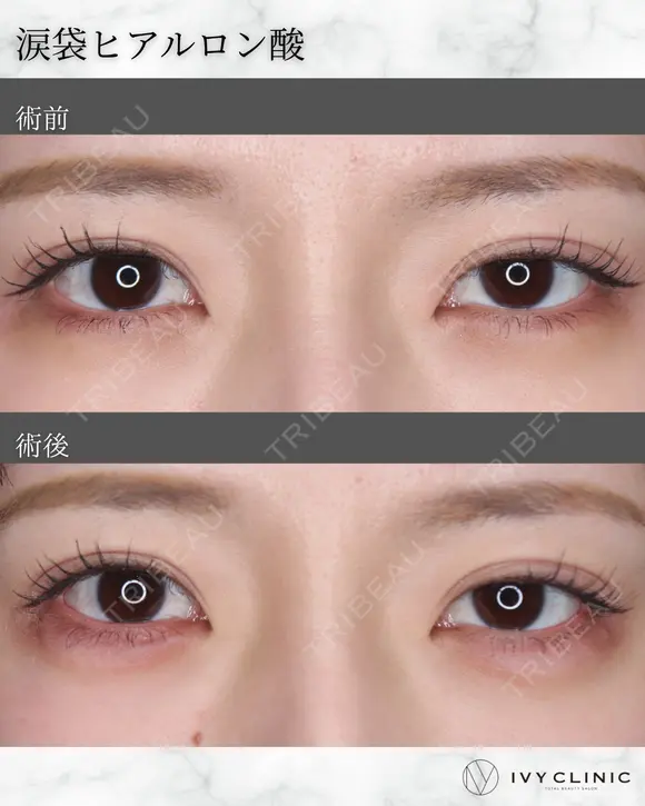 ヒアルロン酸(涙袋) before画像 メイン用