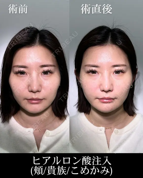 ヒアルロン酸注入（頬/貴族/こめかみ） before画像 メイン用