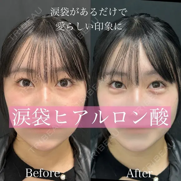 涙袋ヒアルロン酸 before画像 メイン用